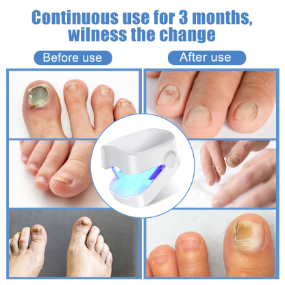 Nail Fungus Laser Treatment LED Light Device(Model:HK702) - Image 5