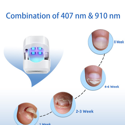 Nail Fungus Laser Treatment LED Light Device(Model:HK702) - Image 3
