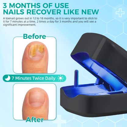 Nail Fungus Laser Treatment LED Light Device(Model:HK702) - Image 4