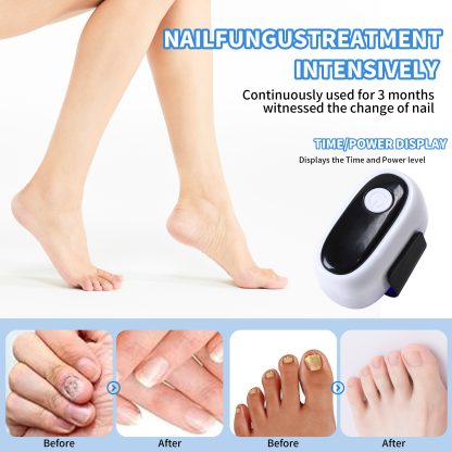 Nail Fungus Laser Treatment LED Light Device(Model:HK705) - Image 3