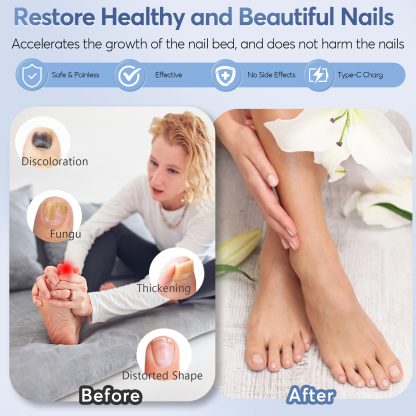 Nail Fungus Laser Treatment LED Light Device(Model:HK704) - Image 6