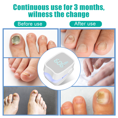 Nail Fungus Laser Treatment LED Light Device(Model:HK703) - Image 7